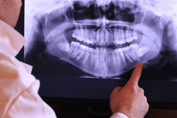 Best Emergency Dentist for Knocked-Out Tooth in Gasport, NY