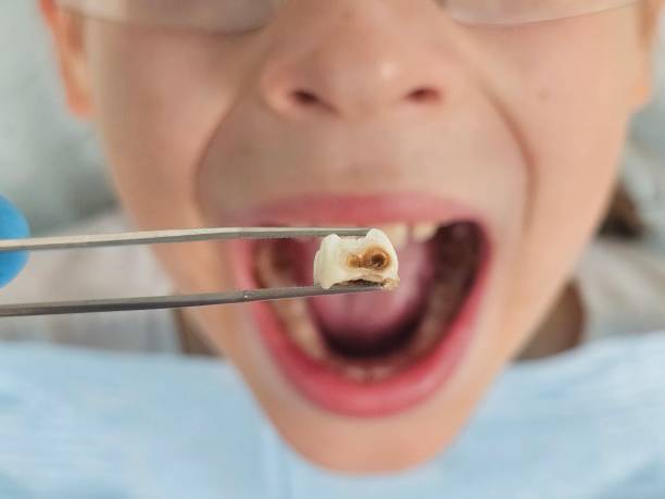 Best Emergency Dental Extractions in Gasport, NY